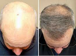 After-Care Tips: A Hair Transplant Guide